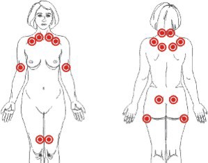 fibromialgia